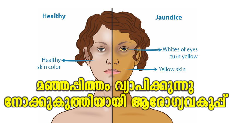 മഞ്ഞപ്പിത്തം : ആശങ്കയില്‍ കോഴിക്കോട് ചങ്ങരോത്ത് പഞ്ചായത്ത്; നോക്കുകുത്തിയായി ആരോഗ്യവകുപ്പ്