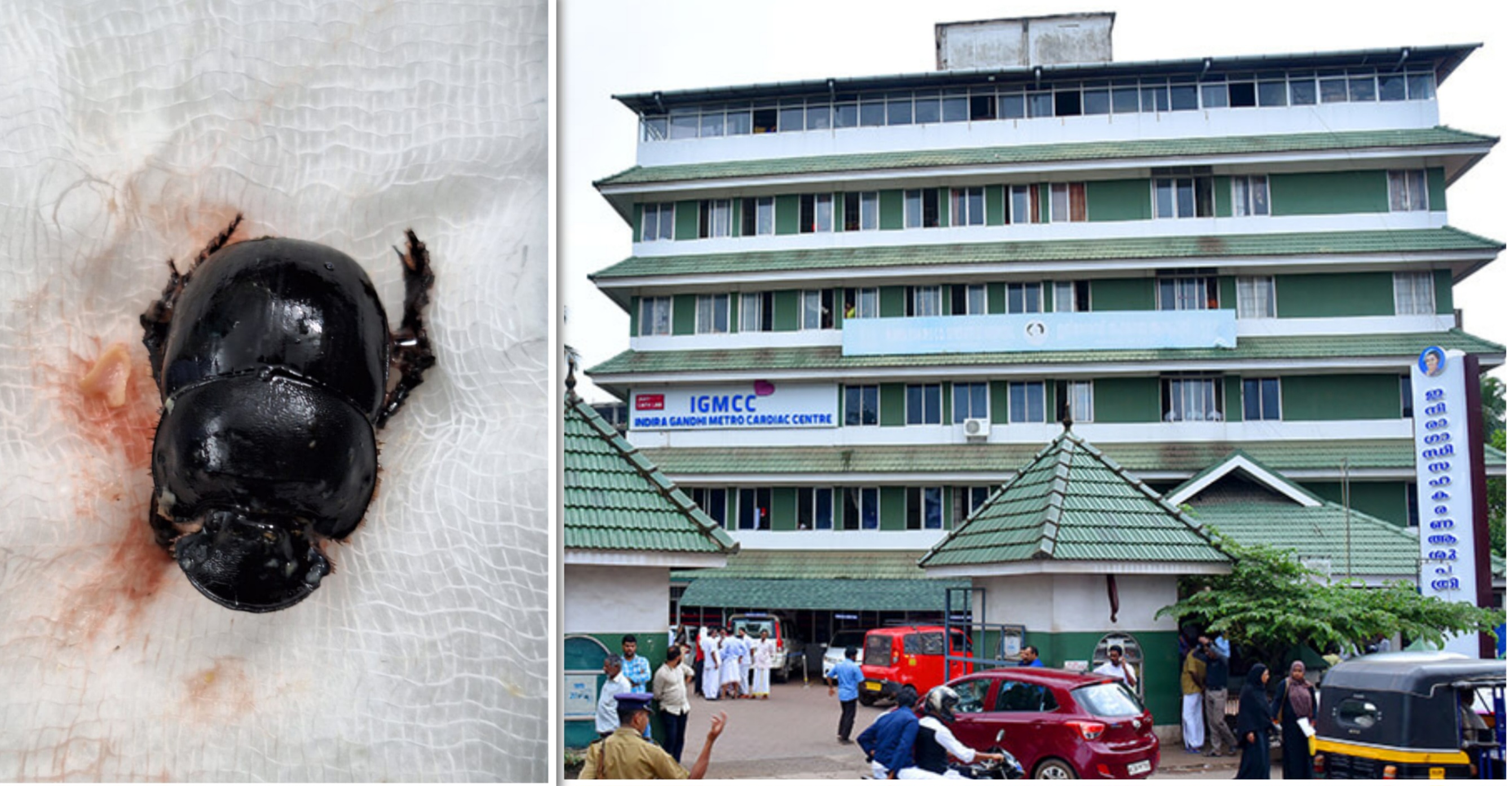 ശ്വാസതടസം നേരിട്ട് പിഞ്ചുകുഞ്ഞ്; തൊണ്ടയിൽ കൊമ്പൻചെല്ലി വണ്ട്: വിദഗ്ധ ചികിത്സയിൽ അത്ഭുത രക്ഷപ്പെടൽ