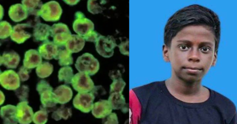കോഴിക്കോട് വീണ്ടും അമീബിക് മസ്തിഷ്ക ജ്വരം ബാധിച്ച് 14 വയസുകാരന്‍ മരിച്ചു; ഒന്നര മാസത്തിനിടെ മരിച്ച കുട്ടികൾ മൂന്നായി